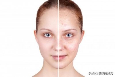 ​盘点痘痘和闭口的区别 凹凸不平的皮肤