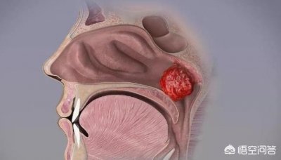 ​早上起来咽口水喉咙痛怎么办(早上起床吞口水喉咙痛怎么办)