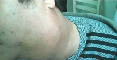 ​艾滋病的早期症状