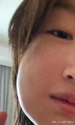 明星拔智齿的脸型变化图（周冬雨拔完智齿脸肿成）(2)