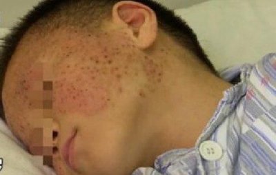 ​玉米男孩图片是什么病 抠虫子原图确实很恐怖