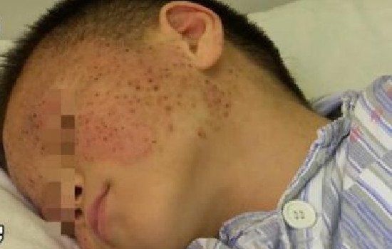 玉米男孩图片是什么病 抠虫子原图确实很恐怖