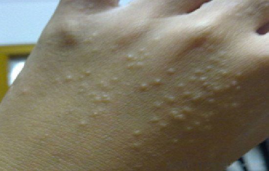 玉米男孩图片是什么病 抠虫子原图确实很恐怖