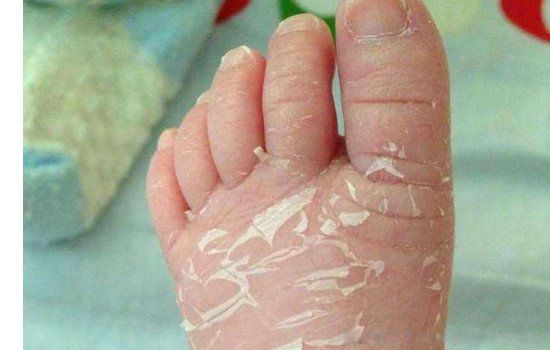 玉米男孩图片是什么病 抠虫子原图确实很恐怖