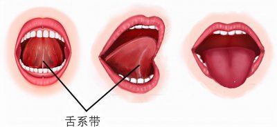 ​新生儿舌系带剪还是不剪？舌系带短有啥危害？