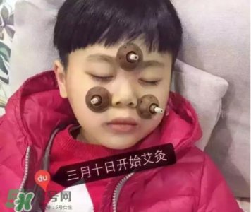 ​艾灸贴可以治咳嗽吗？艾灸贴可以治退烧吗？